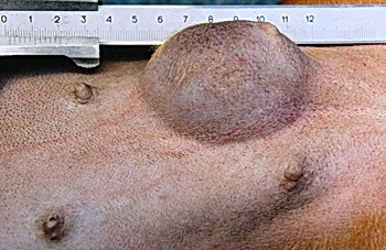 Много симптомов по каким можно определить рак, главное обращать на них внимание и принимать соответствующие меры