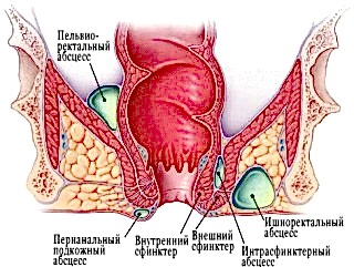 Накопление секрета способствует увеличению анальных пазух, вызывая закупорку желез. Повышенное давление ведет к утончению внутренней стенки железы, и, в крайнем случае, к ее разрыву.